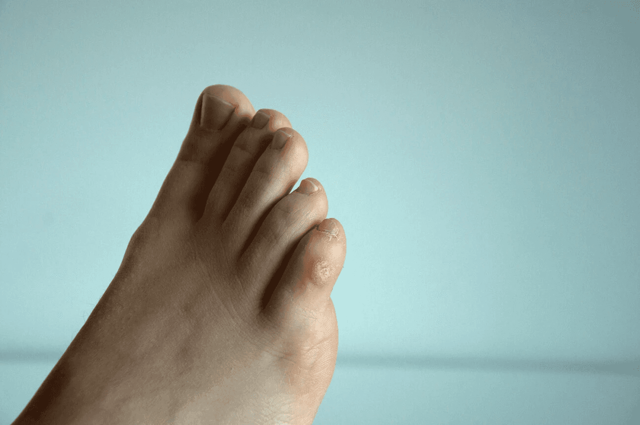 foot with blister